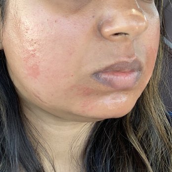 Khoobsurat Threading Salon - Side view of the cheeks and chin burnt - Hair Removal Near Me - Sunnyvale, California