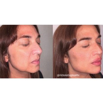 VS Med Spas - Full Face Fillers - Medical Spas Near Me - Beverly Hills, California