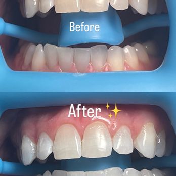 Smile Glo Studio - Before and after! - Teeth Whitening Near Me - Covina, California Smile Glo Studio - Before and after! - Teeth Whitening Near Me - Covina, California