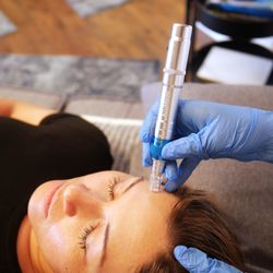 North Shore Acupuncture - Microneedling Treatment Safe, effective way to maintain ageless beauty. Treatments for: Wrinkles, Acne, Hair loss, age spots, stretch marks