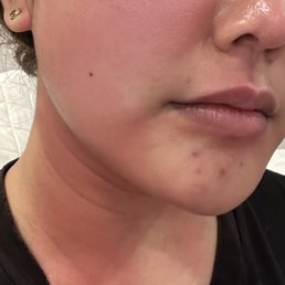 Adverse reactions to the ZO facial. Extreme itching, swelling, and redness. Adverse reactions to the ZO facial. Extreme itching, swelling, and redness.