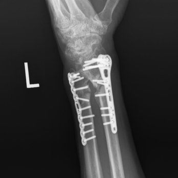 Seropian Law - ORIF surgery for a shattered ulna and radius. When it's this close to the wrist, patients often experience acute-onset carpal tunnel. - Personal Injury Law Near Me - Pasadena, California Seropian Law - ORIF surgery for a shattered ulna and radius. When it's this close to the wrist, patients often experience acute-onset carpal tunnel. - Personal Injury Law Near Me - Pasadena, California