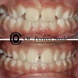 OC Perfect Smile - Airway Expansion