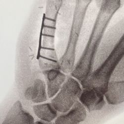 Hand & Wrist Center of Houston - Titanium plate and screws