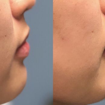 Saami Khalifian, MD - Lip augmentation with juvederm filler - Dermatologists Near Me - Encinitas, California Saami Khalifian, MD - Lip augmentation with juvederm filler - Dermatologists Near Me - Encinitas, California