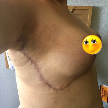 Dr. Alejandro Gálvez - Mini torsoplasty J-scar - Cosmetic Surgeons Near Me - Tijuana, BCN
