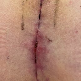 After Dr Katie removed the stitches you can see the skin was separated and bloody.