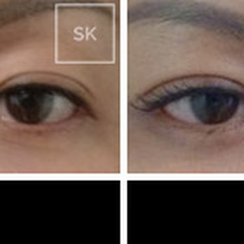 SK Plastic Surgery - This patient underwent revision upper lid blepharoplasty to correct the asymmetry of her folds from a previous surgery by another surgeon. - Cosmetic Surgeons Near Me - Beverly Hills, California SK Plastic Surgery - This patient underwent revision upper lid blepharoplasty to correct the asymmetry of her folds from a previous surgery by another surgeon. - Cosmetic Surgeons Near Me - Beverly Hills, California