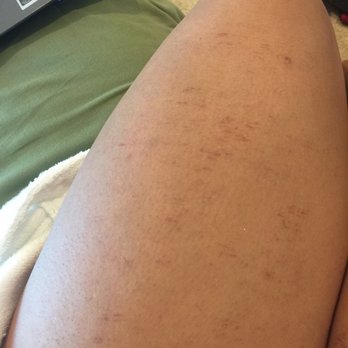 Gravity MedSpa - 5 days after the treatment - Medical Spas Near Me - San Juan Capistrano, California