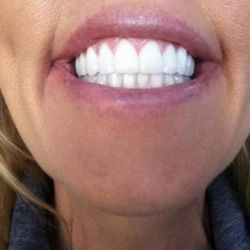Erini P Redmond, DDS - My smile. Thanks to Dr Erini Redmond's!