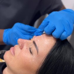 Derm Perfect The Elites' Medspa - Injections of Xeomin into the crow's feet, forehead, and 11 lines