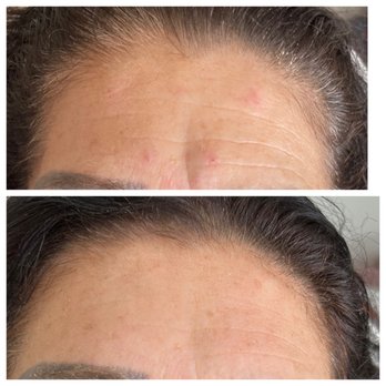 The Luxe Dose - Dysport Before & After - Medical Spas Near Me - Belmont, Massachusetts The Luxe Dose - Dysport Before & After - Medical Spas Near Me - Belmont, Massachusetts