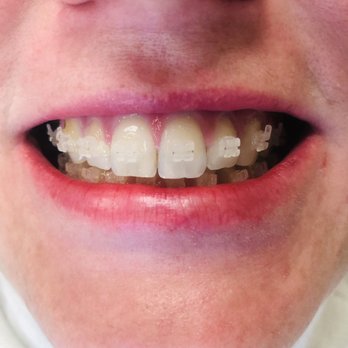 CaliSmile Orthodontics - Orthodontists Near Me - West Hills, California