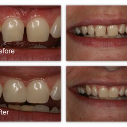 Jack M Hosner - Dr. Hosner bonded material to the teeth to cosmetically enhance.