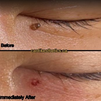Cantik Esthetics - Thermocoagulation Surrey BC - Skin Care Near Me - Surrey, British Columbia Cantik Esthetics - Thermocoagulation Surrey BC - Skin Care Near Me - Surrey, British Columbia