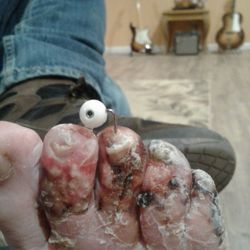 Advanced Foot and Ankle Clinics - After spending a week in the hospital, still one pin remaining, and still getting antibiotics by pic line.