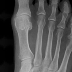 Artin Gevorgian, DPM - Burbank Foot & Ankle Podiatry Center - Before photo. Note tiny bone on left protruding. Also note hace bones connect with other toes.