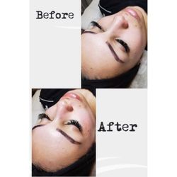Skin Karma - After 1 microdermabrasion