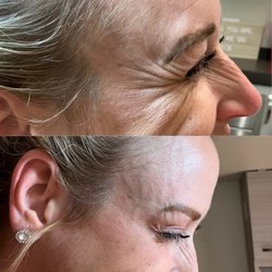 The Refined 209 - Before and After Jeuveau treatment to crows feet
