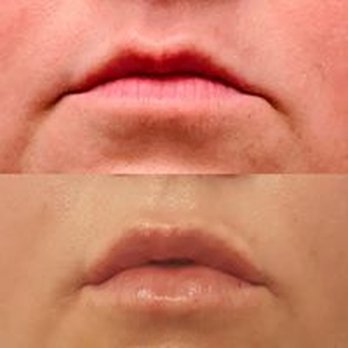 Blue Sage Med Spa - Juvederm - Skin Care Near Me - Amarillo, Texas