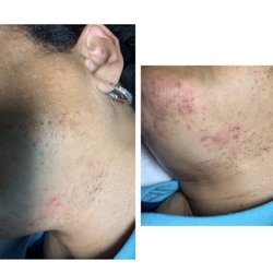 Simply Flawless Electrolysis - Before treatments; Ingrowns causing discoloration and inflammation.