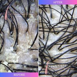 The Pharmacy for Hair Loss & Scalp Disorders - Scalp Dermatitis Treatment - Before & After