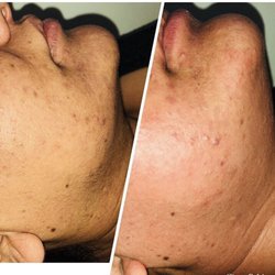 Queens Laser Hair Removal