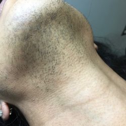 La Moda Electrolysis - Before electrolysis hair removal