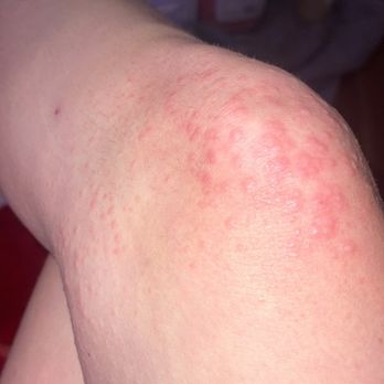 Gravity Extreme Zone - Rash from the bacteria at the trampoline park - Trampoline Parks Near Me - Chandler, Arizona