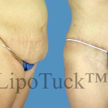 Avante Plastic Surgery - Before and After LipoTuck - Plastic Surgeons Near Me - Houston, Texas