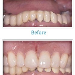 Tompkins Dental - Before and after dentures