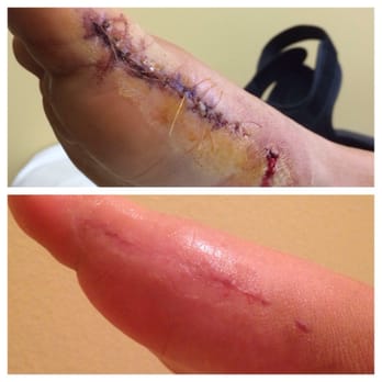Scott K Forman, MD - Sorry for how gross this looks but it's healing up so well! That's after 6 weeks - Orthopedists Near Me - Newport Beach, California Scott K Forman, MD - Sorry for how gross this looks but it's healing up so well! That's after 6 weeks - Orthopedists Near Me - Newport Beach, California