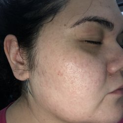 House of Glam Hawaii - Weeks after doing Microdermabrasion and microneedling