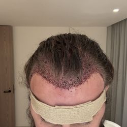 Abrams Aesthetics And Hair Restoration - Day 2 progress