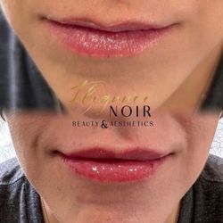 Elegance Noir Beauty & Aesthetics - Lip fillers, natural look