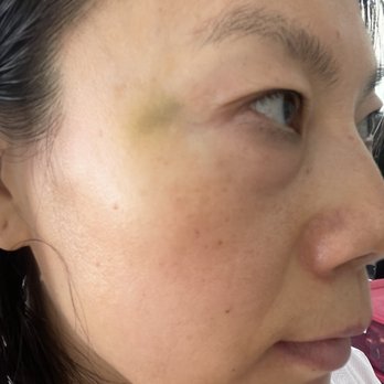 Hiatus Day Spa • Med Spa - Update on my reviews: I had my Botox done on 01/21 and today is 01/28. My bruise is still not gone yet on both sides. - Day Spas Near Me - Plano, Texas