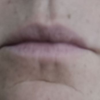 Kimberly Jones Esthetics Micro Spa - Before. As you can see. My lips were the same color as my skin. - Skin Care Near Me - San Francisco, California