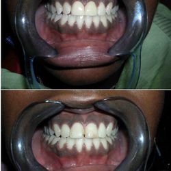 Eva Karmo, DDS - Another happy patient with 2 front veneers