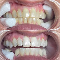 Glitz Laserz - Before and after