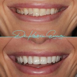 Kaori C Ema, DDS - Beautiful, natural looking veneers