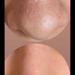 Mimi’s Magical Beauty Bar - Up close of nose before& after facial treatments.
