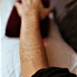 Misty Mountain Acupuncture - Acupuncture
