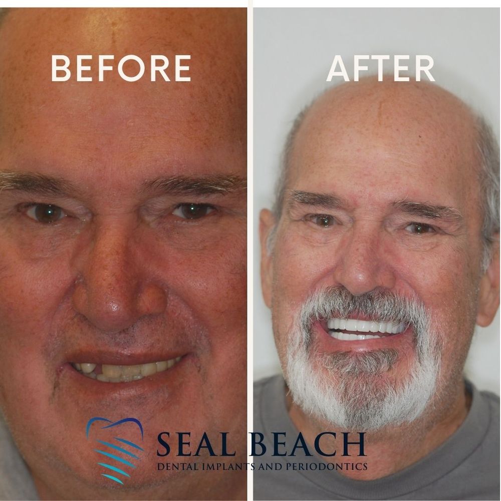 SEAL BEACH DENTAL IMPLANTS Updated September 2024 23 Reviews 2999