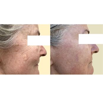 Skin Harmonics - possible precursor lesion transformation - Skin Care Near Me - Summerland, California Skin Harmonics - possible precursor lesion transformation - Skin Care Near Me - Summerland, California