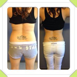 Mats Hagstrom, MD - Liposuction of her abdomen waist and hips. Photo taken two weeks after the procedure. Procedure done with local anesthesia and mild sedation