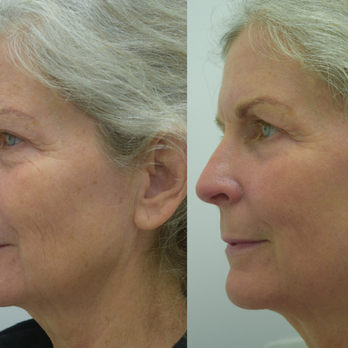 Skin Deep Laser Services - Tattoo Removal Near Me - Burke, Virginia