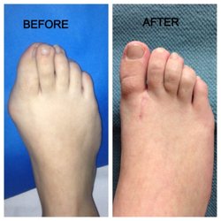 The Foot Care Group - bunion deformity