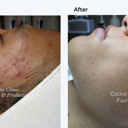Skin Esteem - Face Reality Acne Clearing Program.