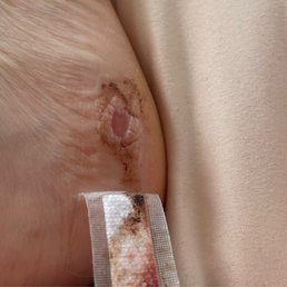 Skin removed off of my foot. Skin removed off of my foot.