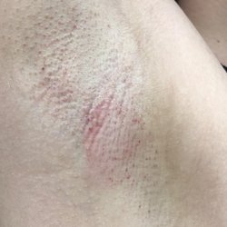 Simply Beauty - Wax burn from lack of preparation and negligence. You can still see the hair left as well.